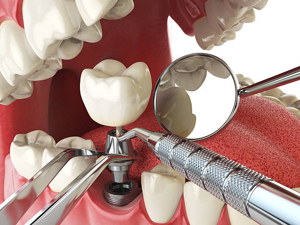 Best Cracked Tooth Emergency Dentist  in Walnut Grove, GA